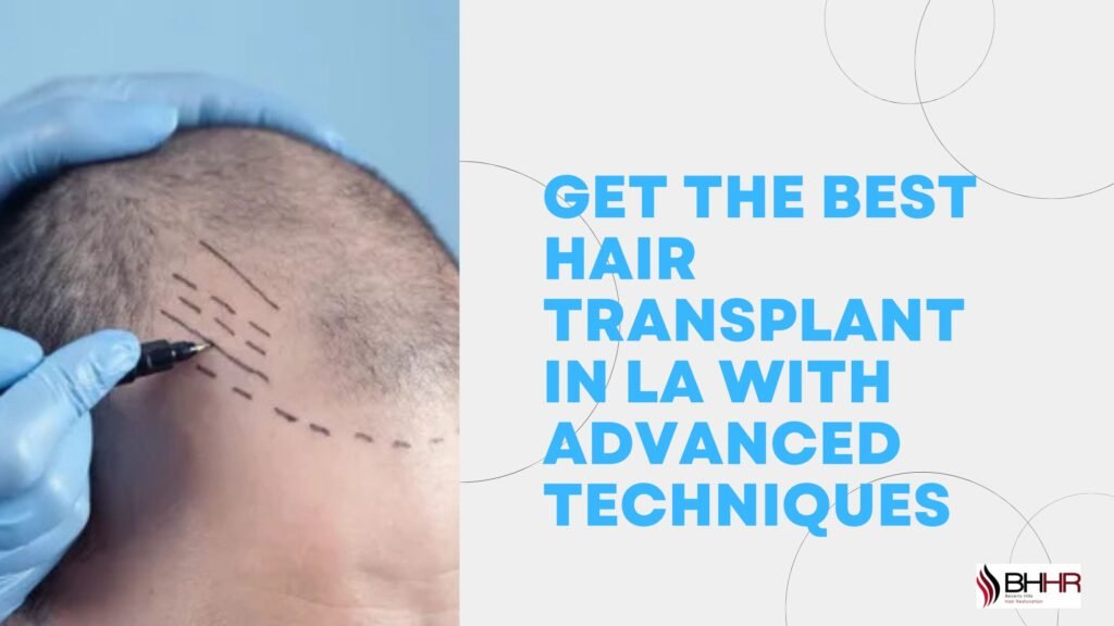 Get the Best Hair Transplant in LA with Advanced Techniques best hair transplant in la