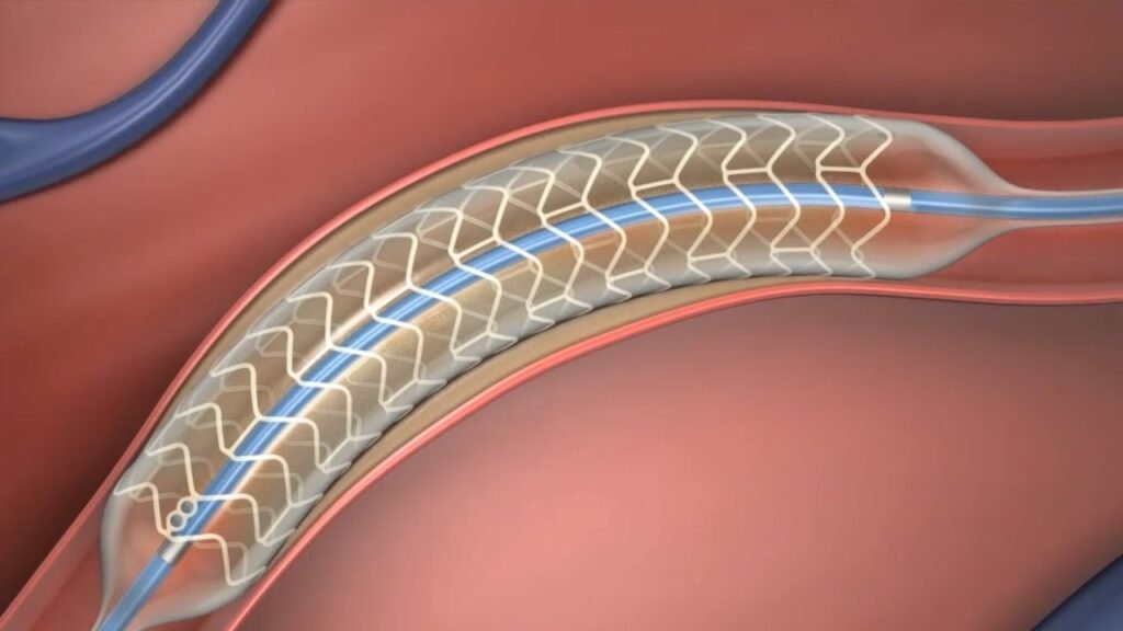 Bioabsorbable Stents Market