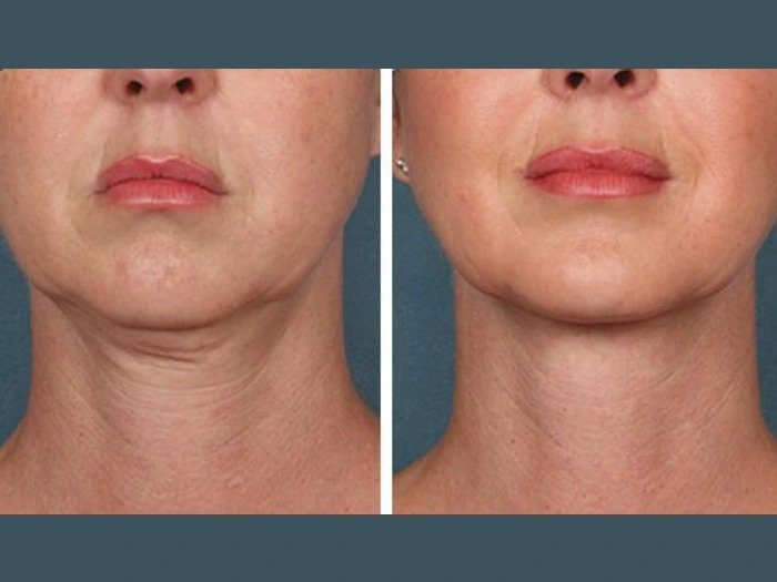 Best Aesthetic Clinics in Dubai PRP Injections Skin Boost Prp Treatment in Dubai