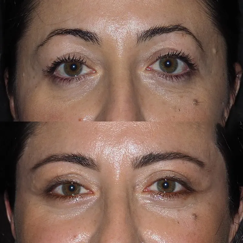 Is Eye Bag Removal Worth It? Best Eye bag removal Surgeon in dubai Opinion Eye Bag Removal in Dubai