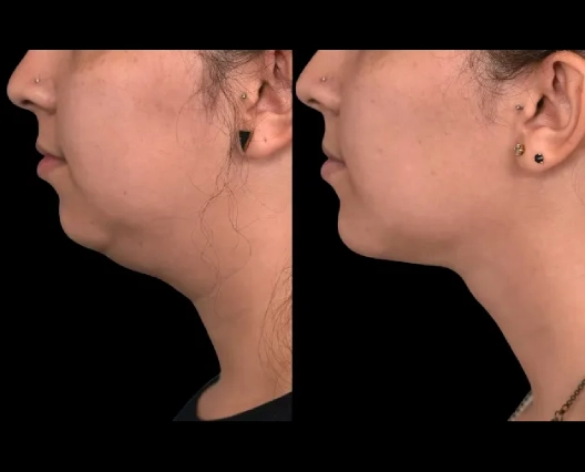 Best Double chin removal Surgeon in dubai Expert Choice Double chin removal in Dubai
