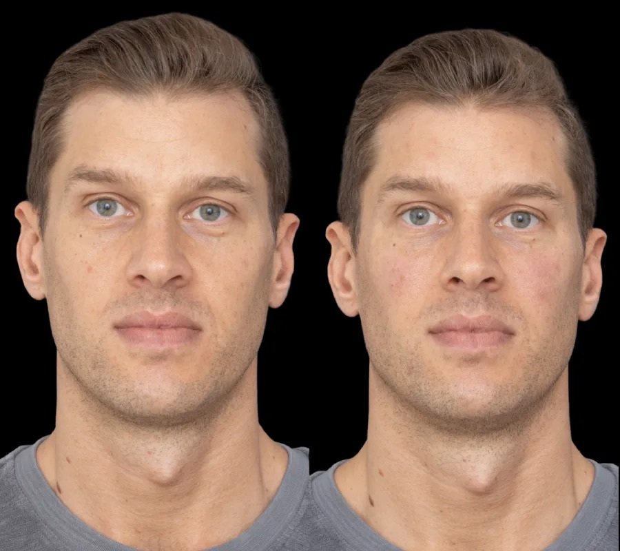 Best Doctors in Dubai Reveal Modern Trends in Under Eye Fillers under eye fillers