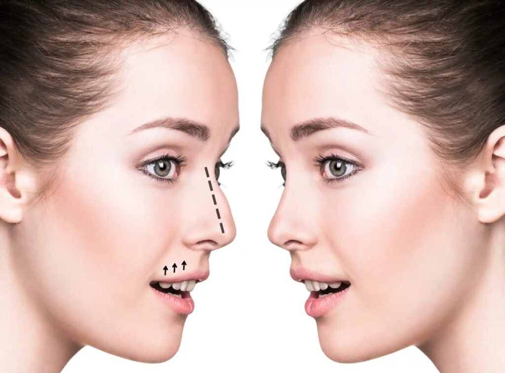 Rhinoplasty in Dubai