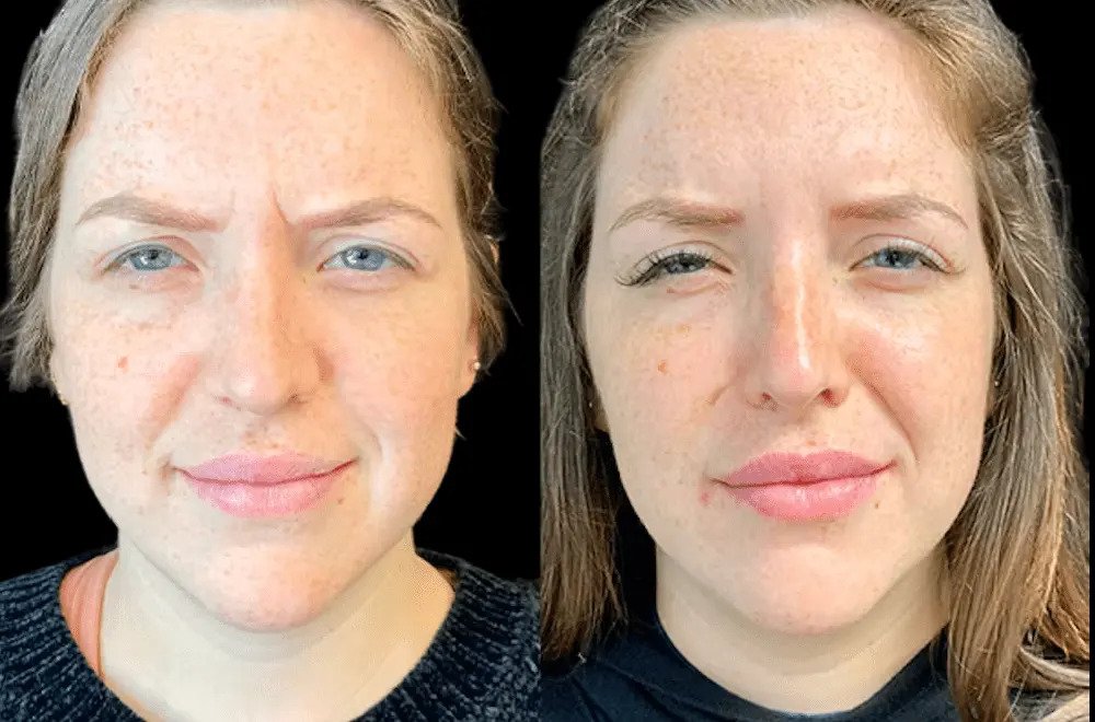 Botox in Dubai Before and After Results Guide Botox in Dubai Before and After Results Guide