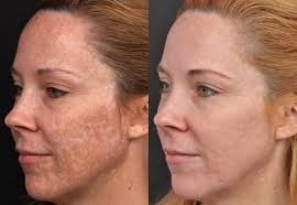Depigmentation in Altrincham: Benefits of Depigmentation Treatment Depigmentation in Altrincham