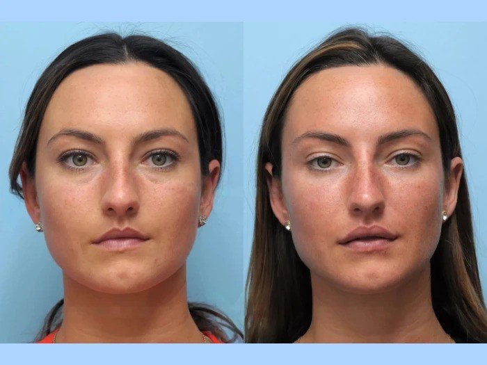 Thread Lift in Dubai Innovative Approach to Non Surgical Facial Lifting Thread Lift in Dubai Innovative Approach to Non Surgical Facial Lifting