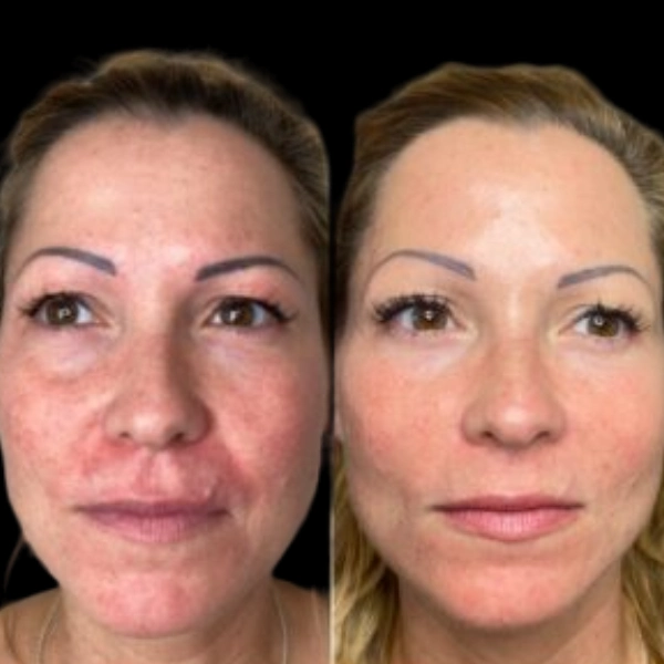 Profhilo Treatments in Dubai for Cellular Skin Renewal Support Profhilo in Dubai