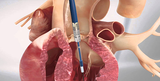 Understanding Treatment Choices and Recovery in Cardiac Valve Care Treatment