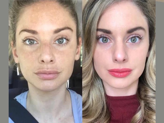 High-Precision Radiofrequency (RF) Microneedling Treatments in Dubai Radiofrequency (RF) Microneedling in Dubai