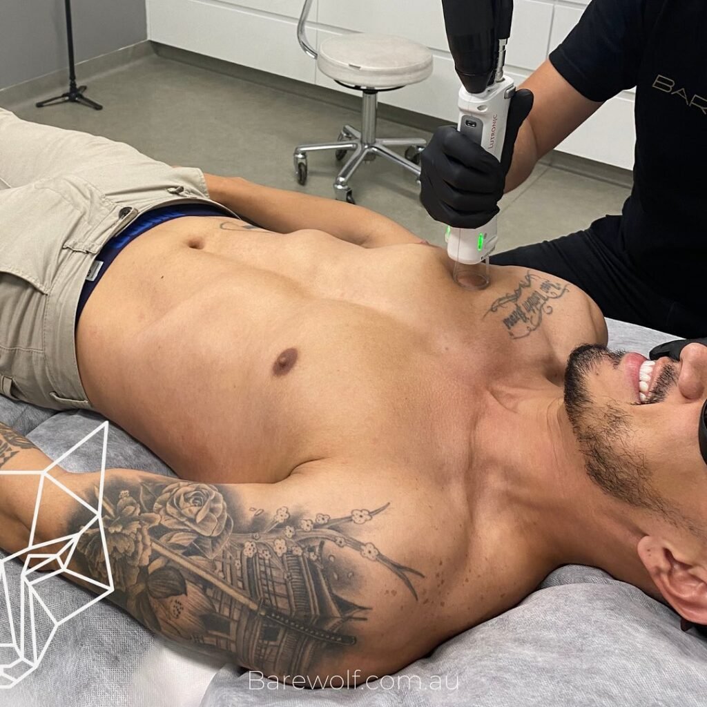 Body Hair Removal For Men Sydney