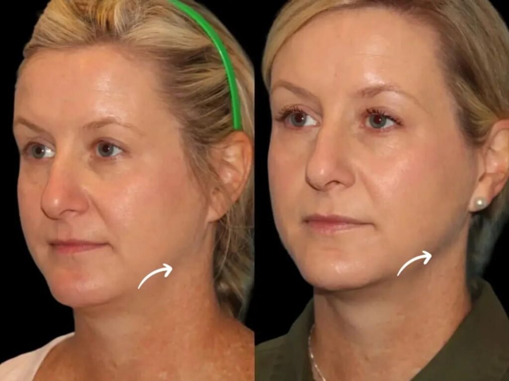 sculptra fillers in dubai