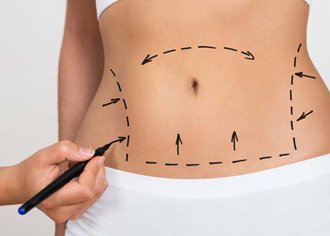 Best Areas to Treat with Liposuction in Islamabad for Visible Results liposuction in islamabad