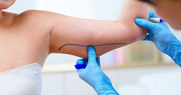 جراحة شفط الدهون في دبي لنحت كامل الجذع Liposuction surgery in Dubai