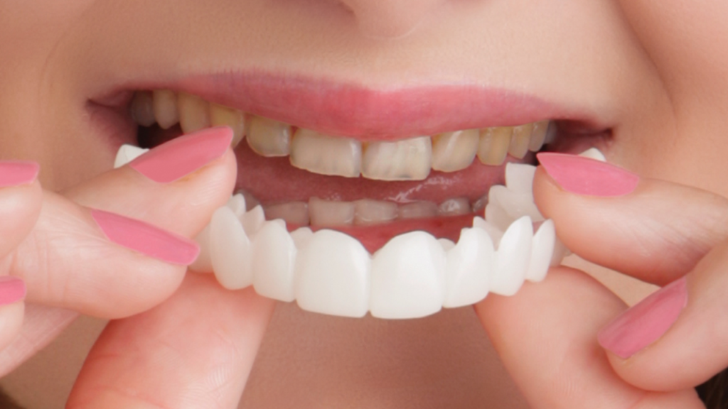 6 Month Braces