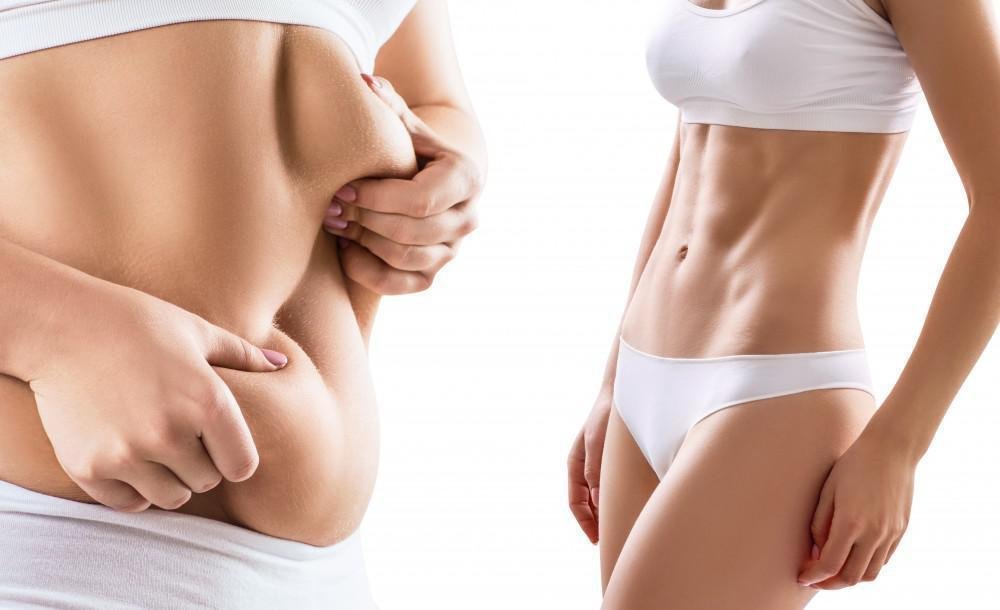 Liposuction Surgery in Dubai Precision Safety and Beauty Liposuction in Dubai