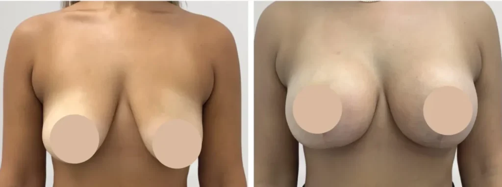 Best Doctors in Dubai for Breast Reduction and Exceptional Aesthetic Outcomes Breast Reduction in Dubai