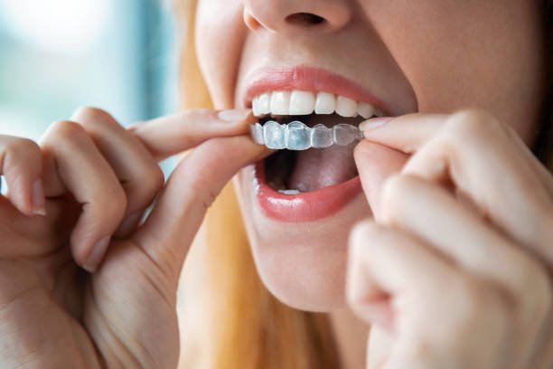 A Clear Path to a Healthier Smile with Modern Aligner Treatment
