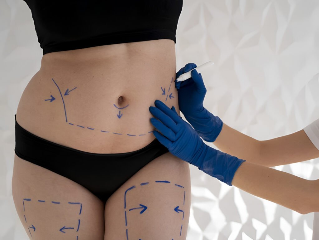 Everything You Need to Know About Liposuction in Islamabad liposuction in Islamabad