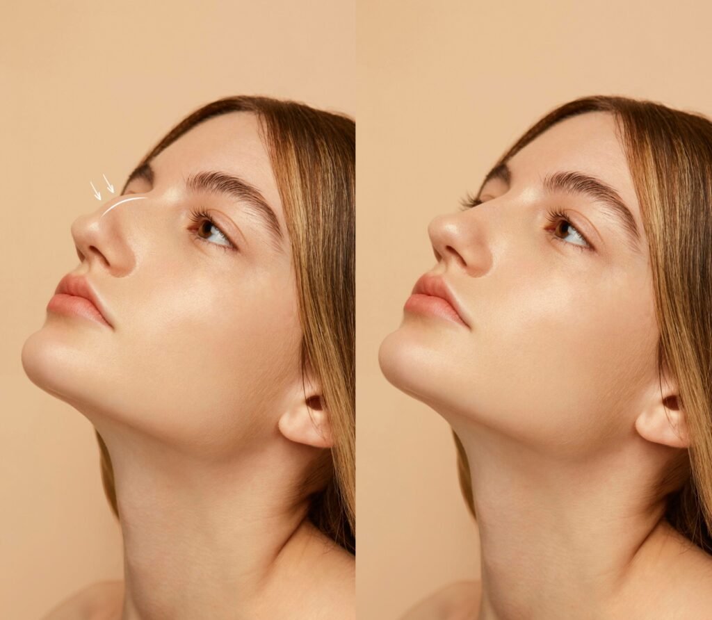 7 Important Things to Know About Rhinoplasty Before and After Results rhinoplasty before and after