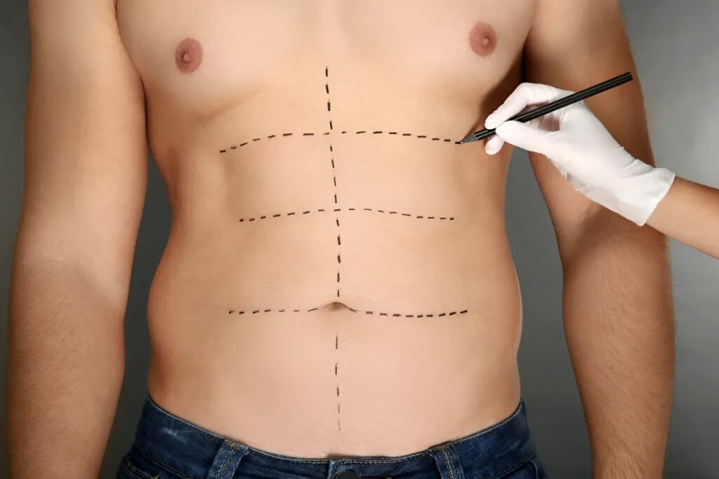 Best Candidates for Tummy Tuck Surgery in Islamabad tummy tuck surgery in islamabad
