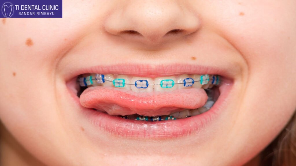 The Full Smile Makeover Cost Blueprint: Planning for 4, 6, 8, or More Veneers